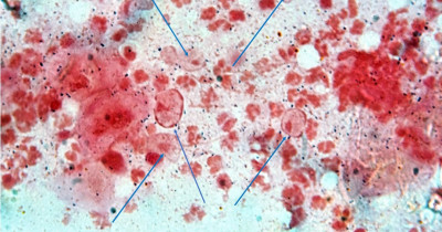 Trichomonas Trichomonas