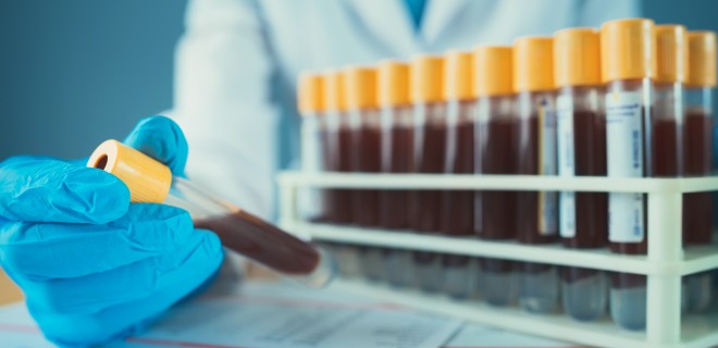 A gloved hand holding a vial of blood whilst many others are lined up on a table.